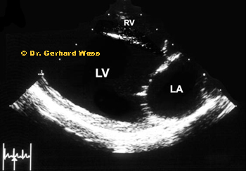 Echocardiographic image showing left heart enlargement in PDA